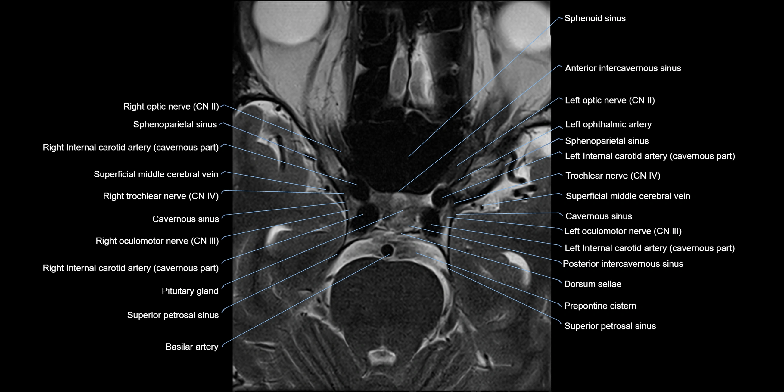 MRI cavernous sinus axial cross sectional 3T anatomy image-img-11001-00012.webp